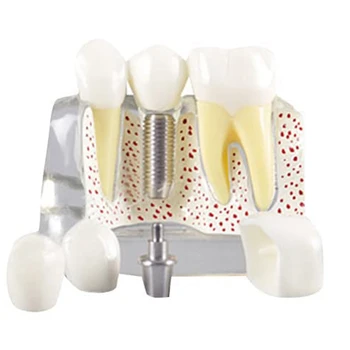 Dantų Demonstravimas Modelis Implantas Nuimamas Analizė Karūna Tiltas -Paciento Bendravimas