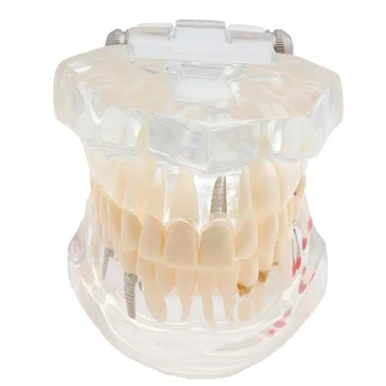 Dantų Modelio Dantų Modelio Implantas ir Restauravimo Skaidrus Analizė Demonstravimo su Restauravimo Tiltas