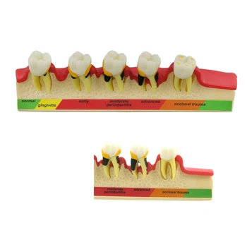 Dantų Periodonto Ligos Modelis Dantų Dervų Modelis Pažangą, Šaknų Kanalų Gydymas Odontologijos Mokosi Mokymo Demo